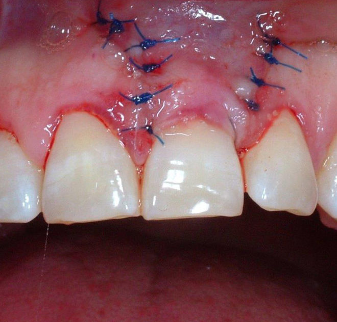 verident-terapie-chirurgia-mini-invasiva (1)