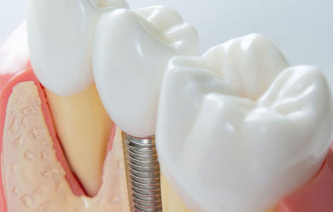 verident-terapie-implantologia-3