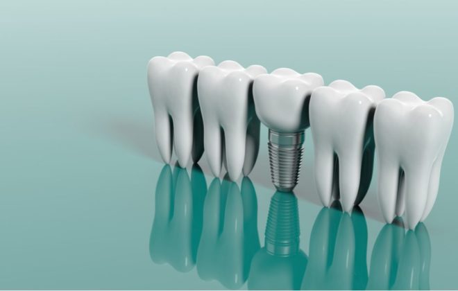 verident-terapie-implantologia-4