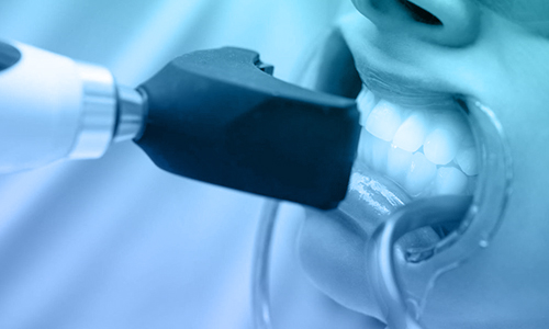 verident_sbiancamento